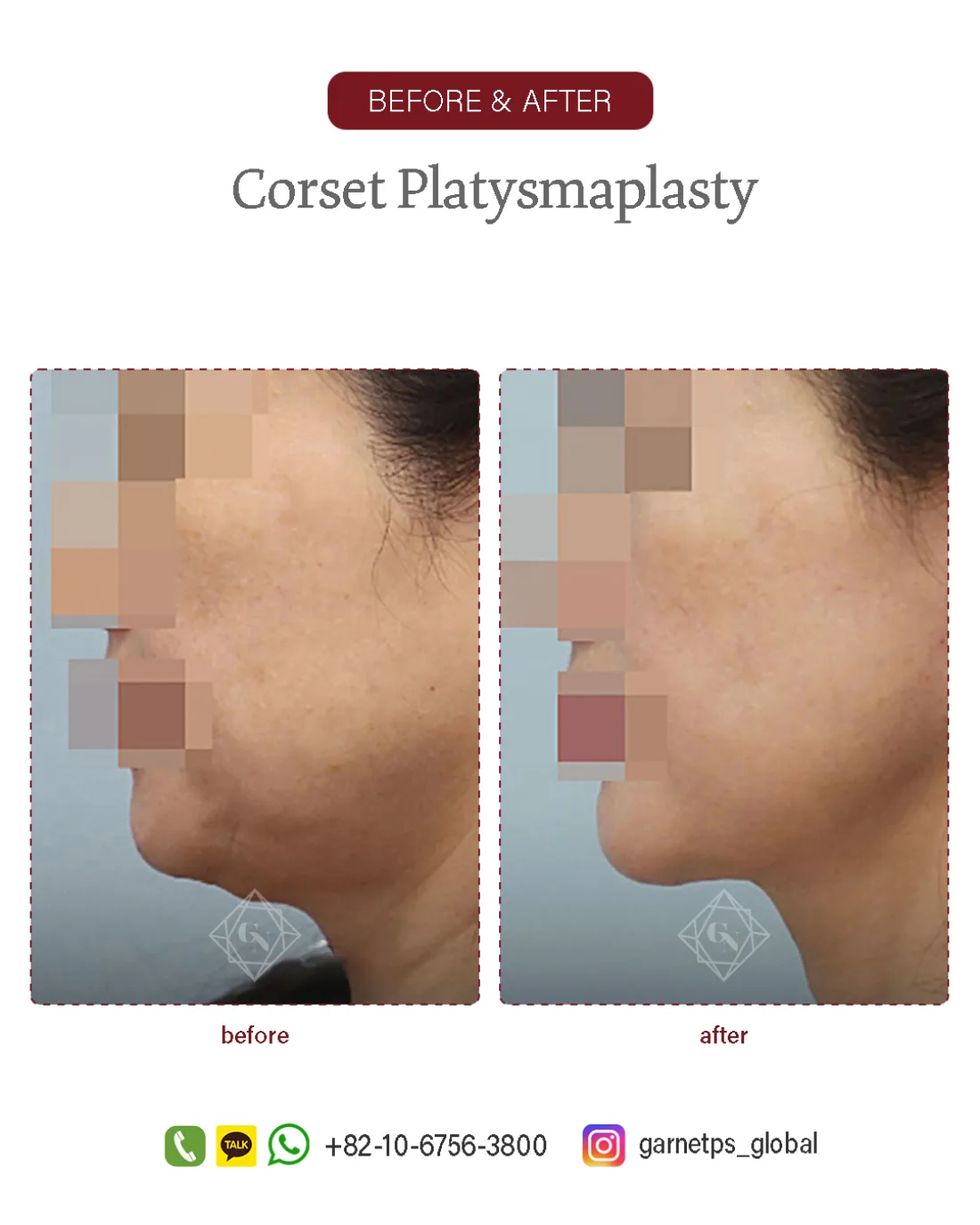 Corset platysmaplasty result at Garnet Plastic Surgery, Apgujeong
