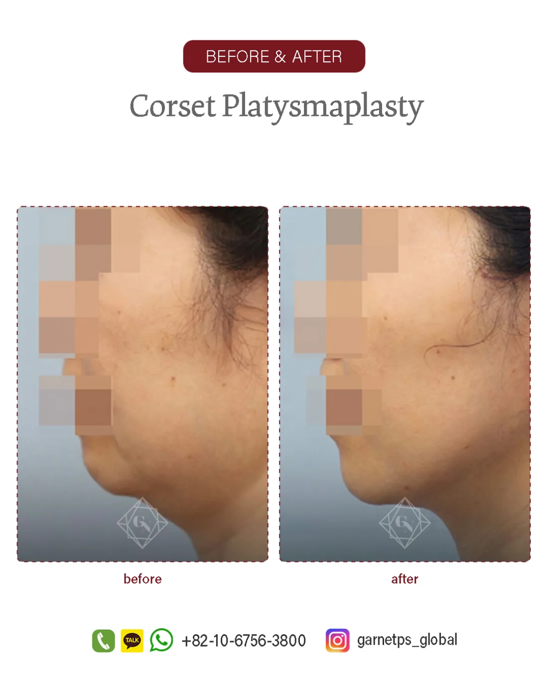Corset platysmaplasty result at Garnet Plastic Surgery, Apgujeong