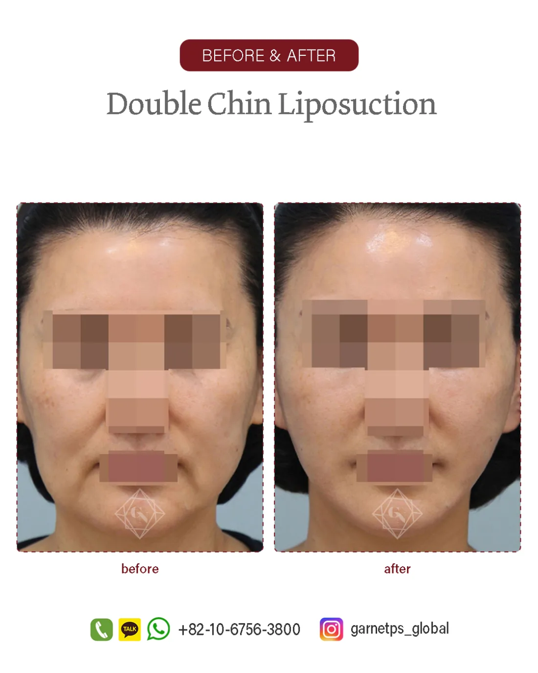 Facial liposuction result at Garnet Plastic Surgery, Apgujeong