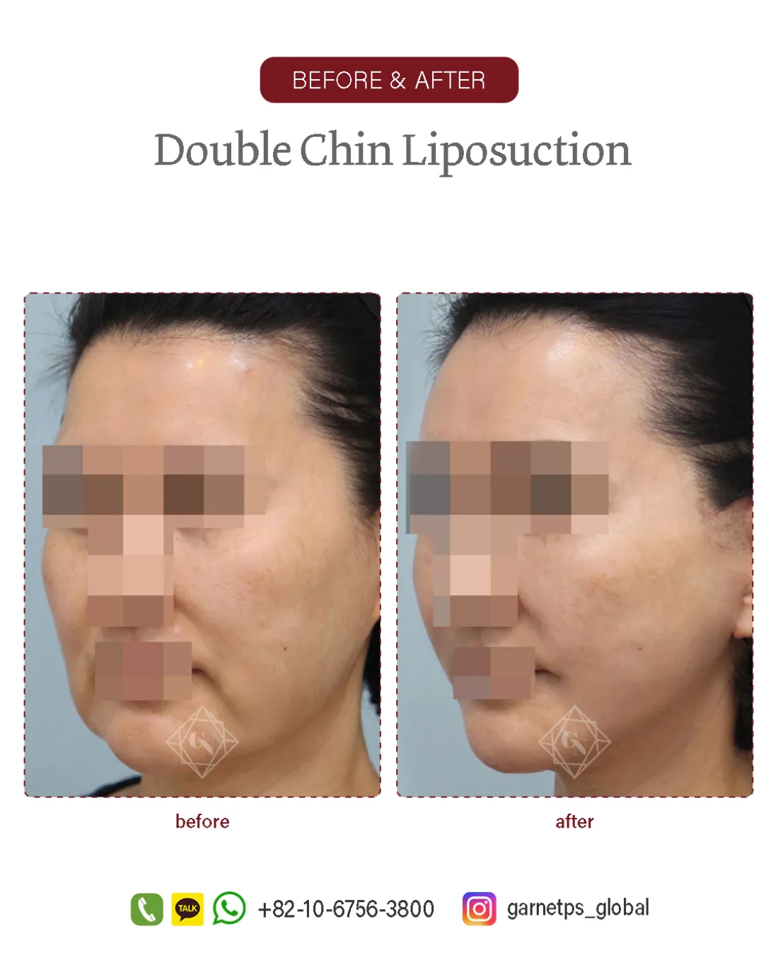Facial liposuction result at Garnet Plastic Surgery, Apgujeong