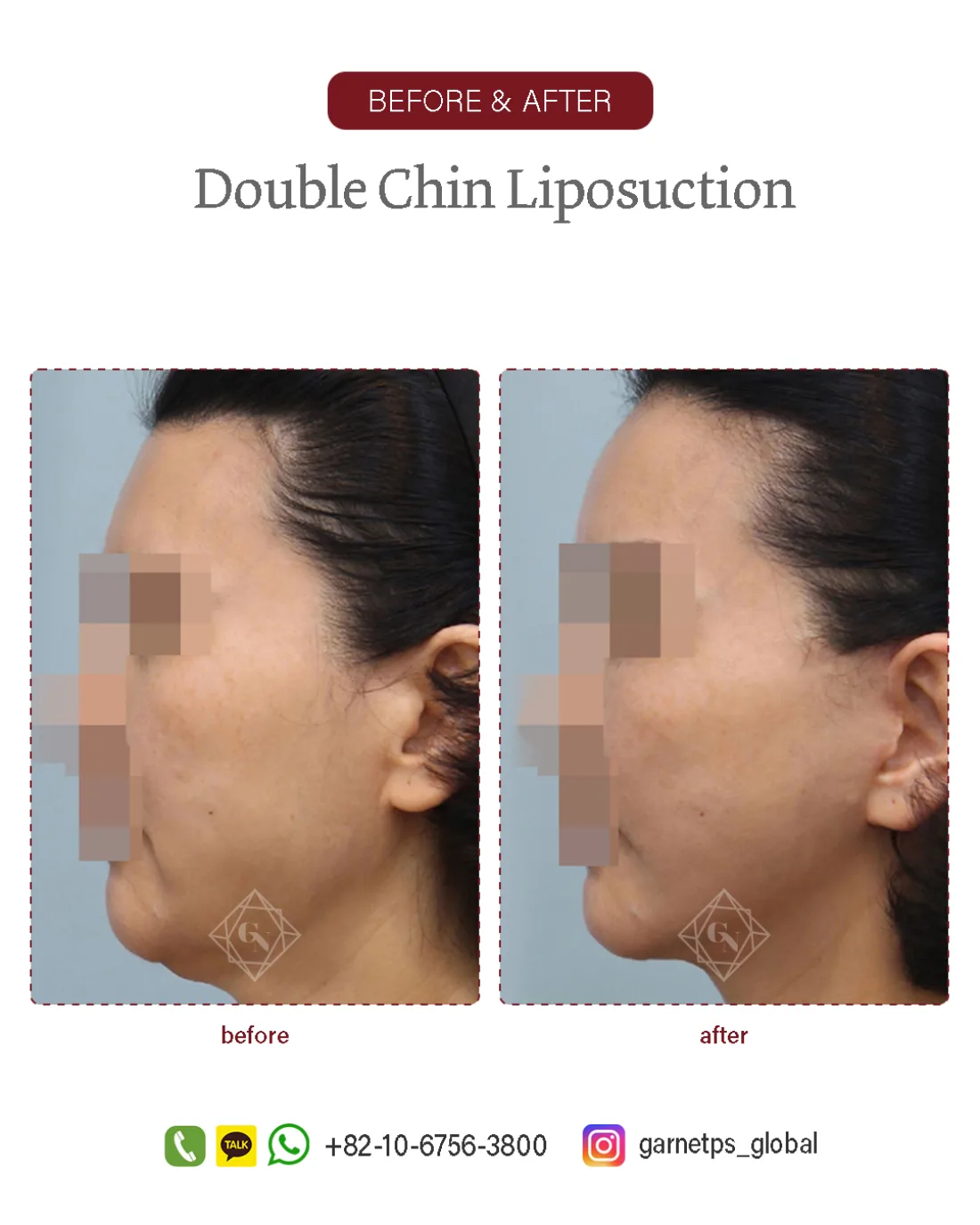 Facial liposuction result at Garnet Plastic Surgery, Apgujeong