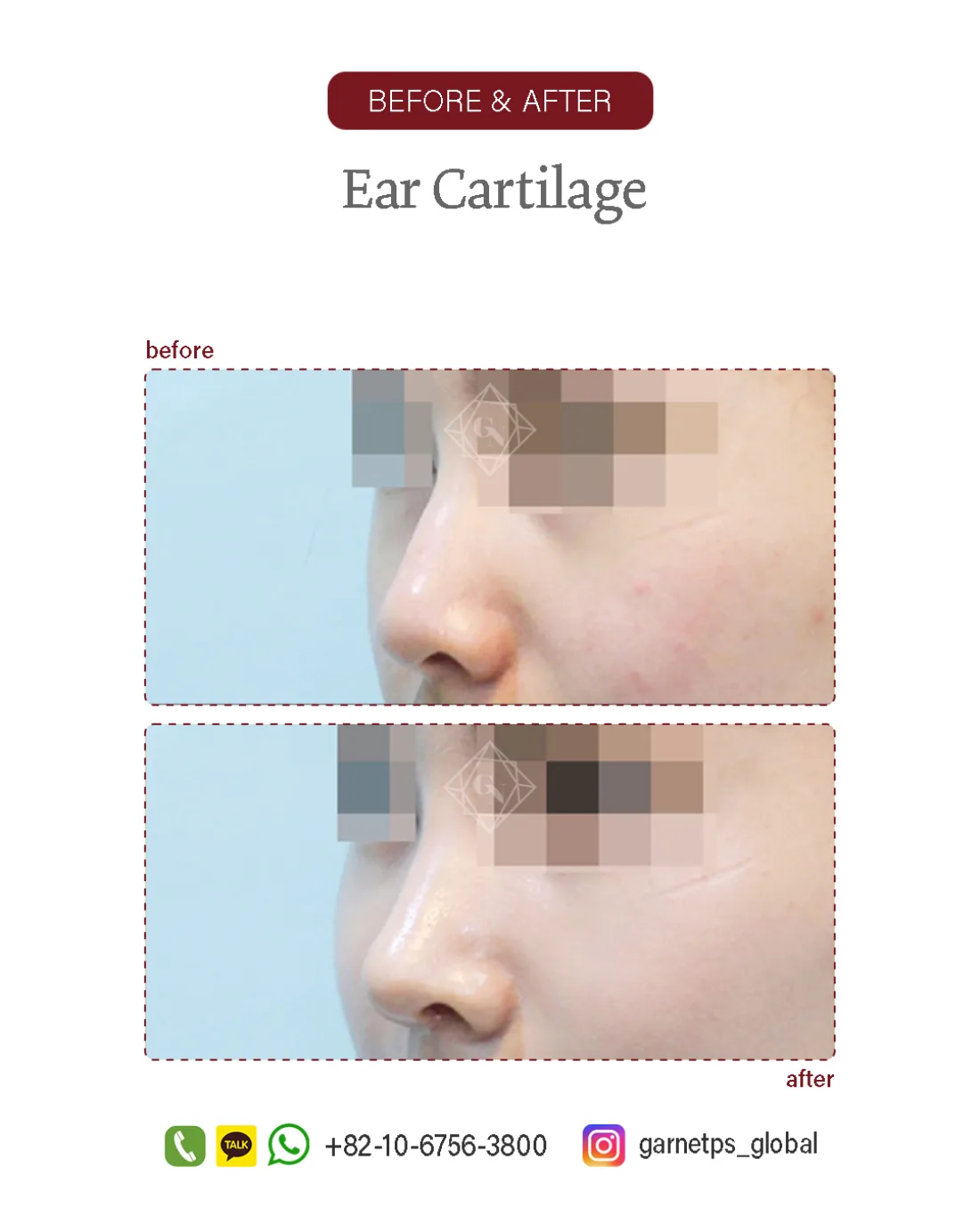 Septal/ear-cartilage rhinoplasty result at Garnet Plastic Surgery, Apgujeong