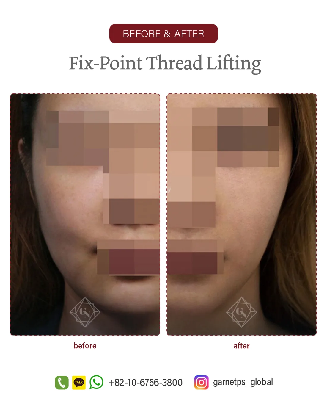 Fixpoint Thread Lift™ result at Garnet Plastic Surgery, Apgujeong