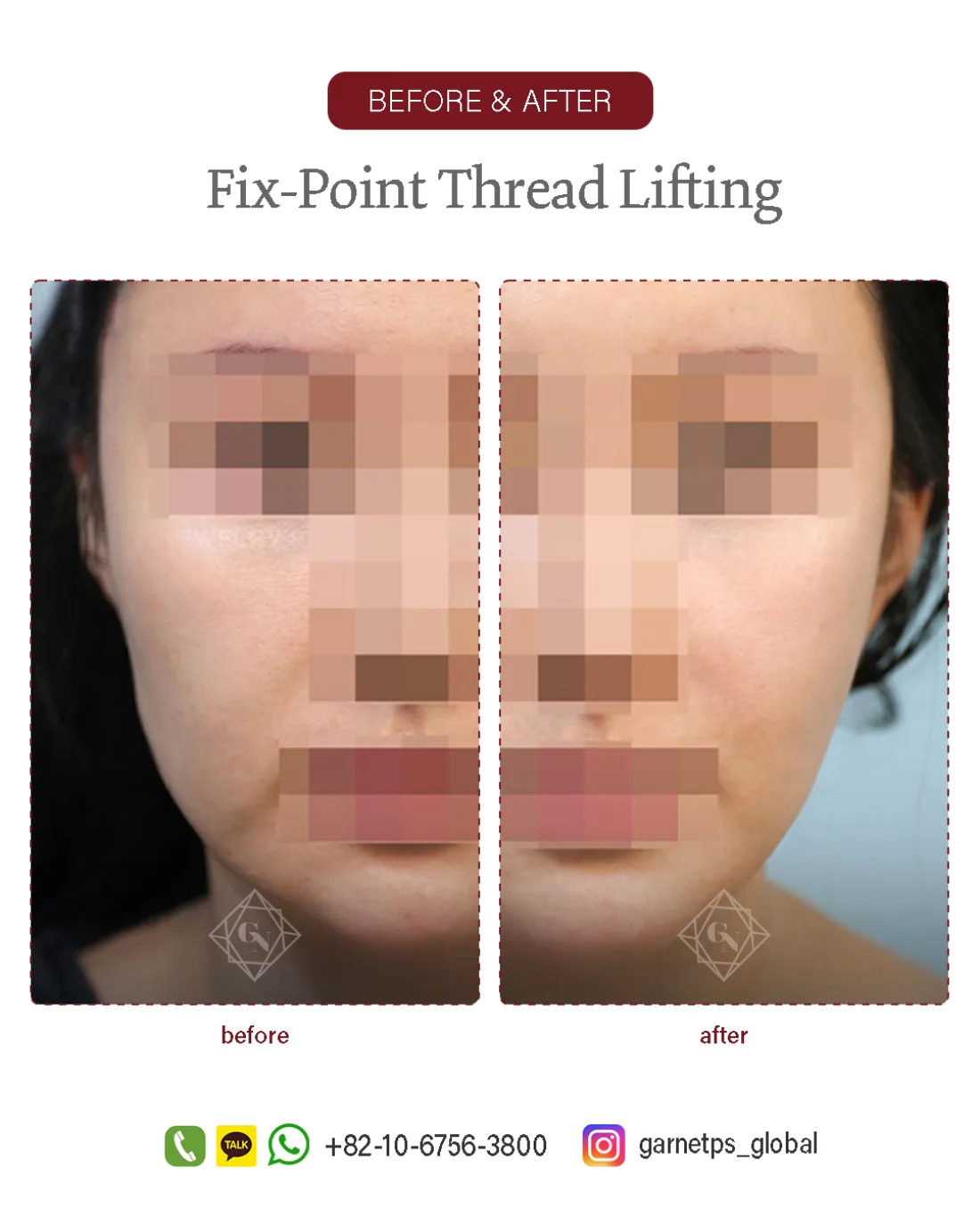 Fixpoint Thread Lift™ result at Garnet Plastic Surgery, Apgujeong