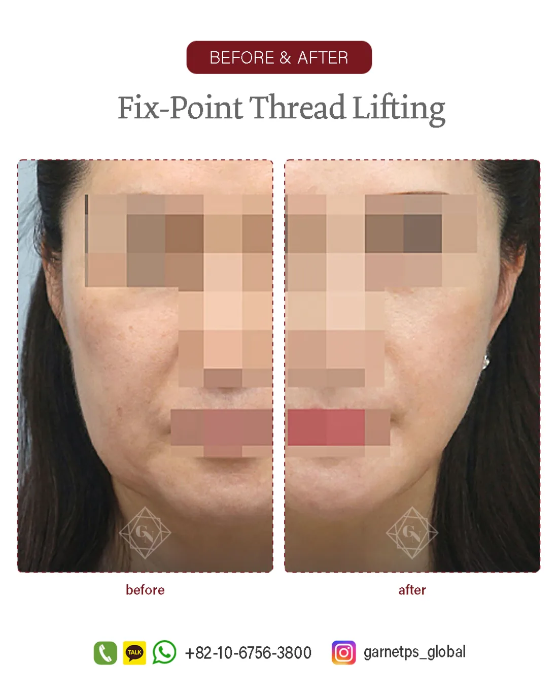 Fixpoint Thread Lift™ result at Garnet Plastic Surgery, Apgujeong