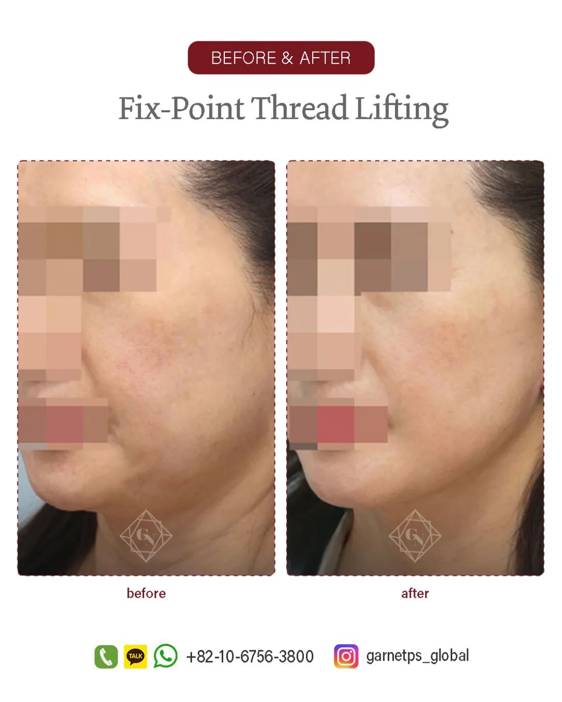 Fixpoint Thread Lift™ result at Garnet Plastic Surgery, Apgujeong
