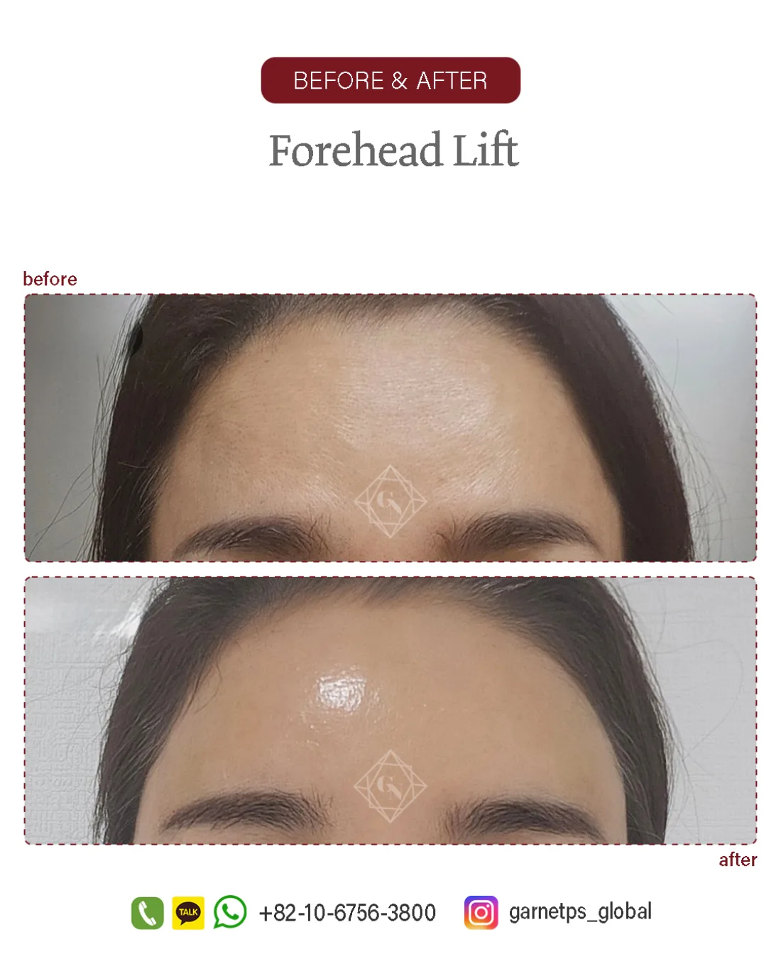 Forehead reduction result at Garnet Plastic Surgery, Apgujeong