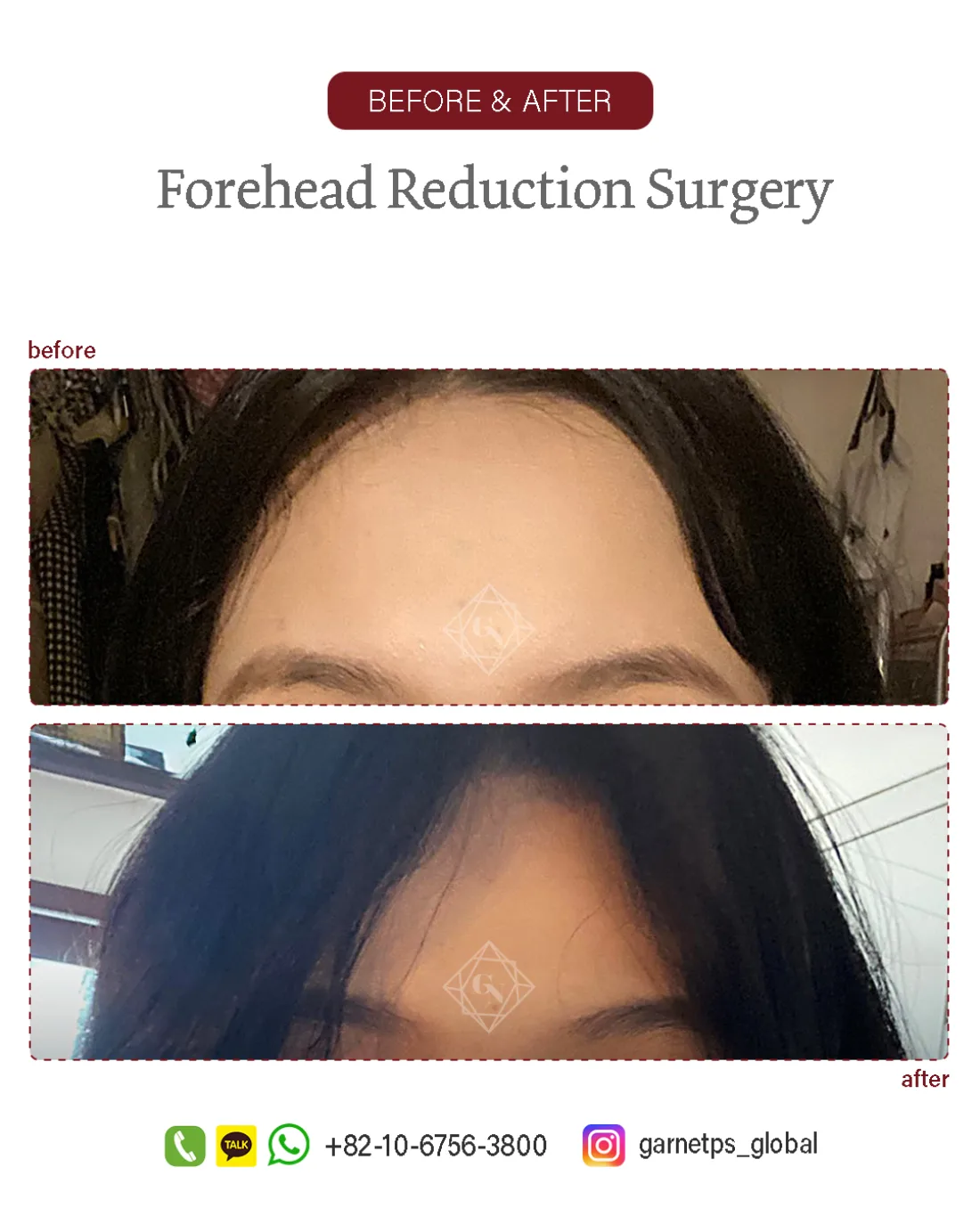 Forehead reduction result at Garnet Plastic Surgery, Apgujeong