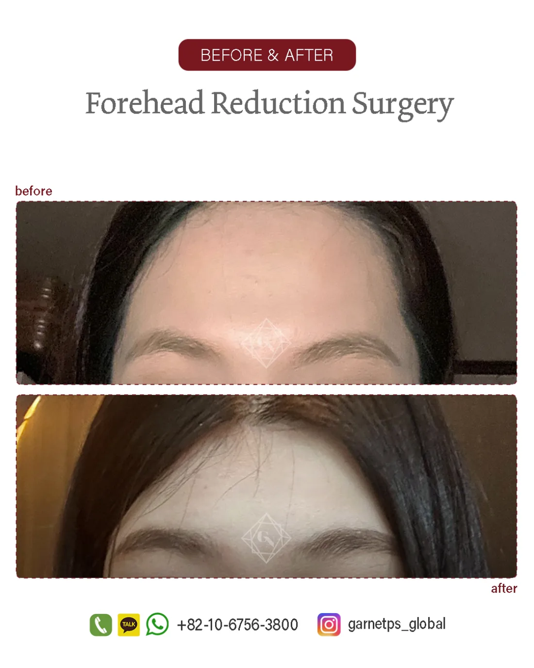 Forehead reduction result at Garnet Plastic Surgery, Apgujeong