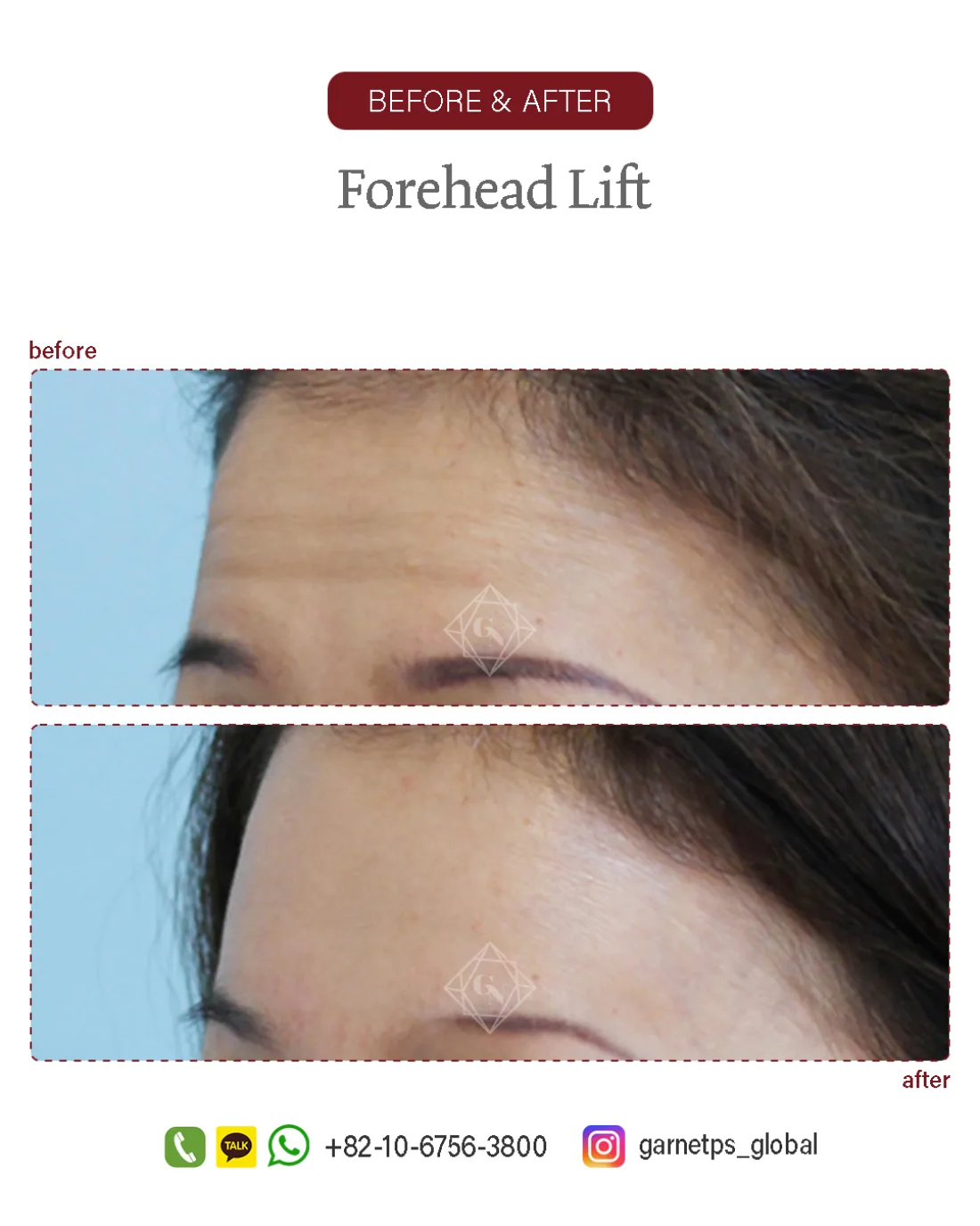Forehead reduction result at Garnet Plastic Surgery, Apgujeong