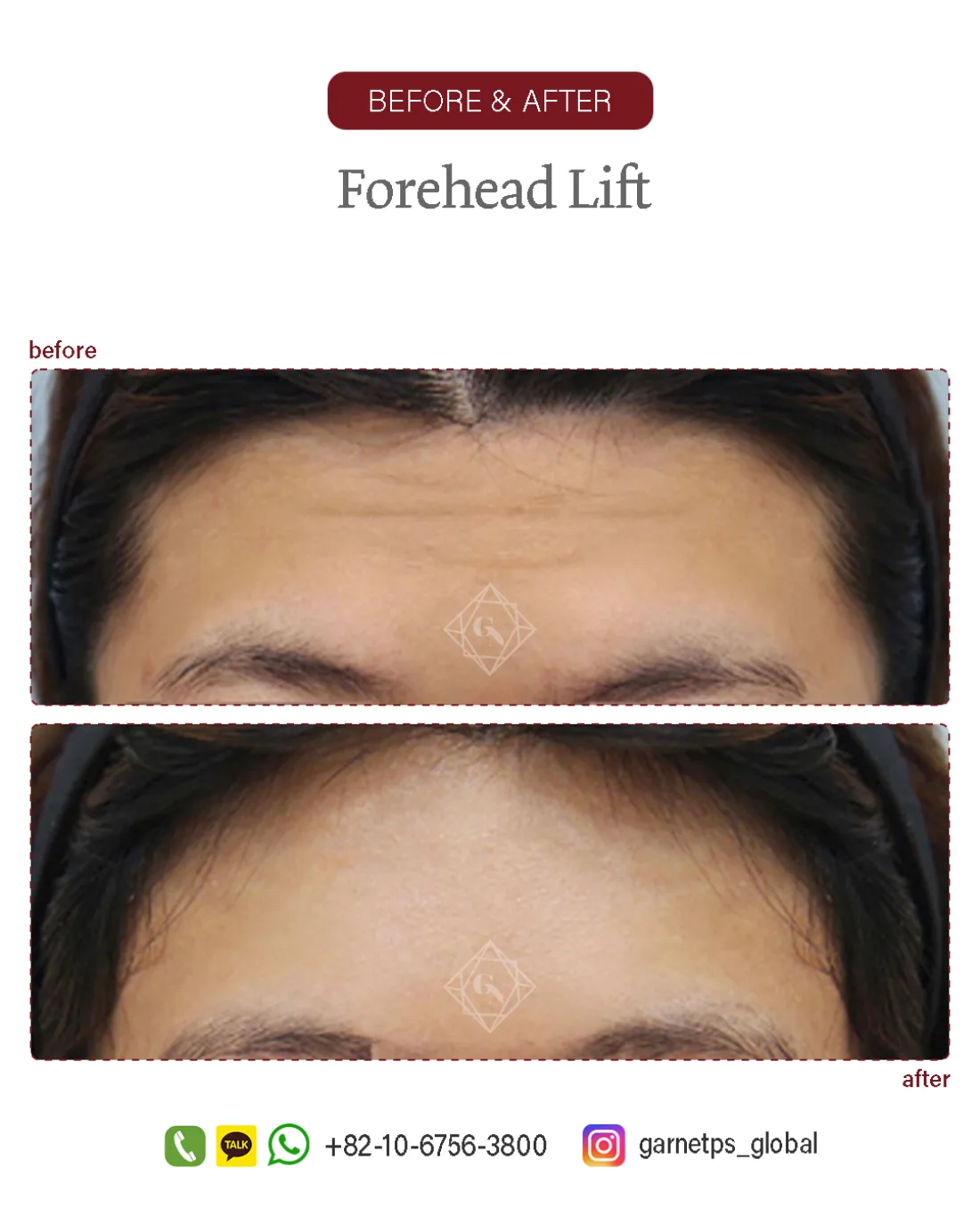 Forehead reduction result at Garnet Plastic Surgery, Apgujeong