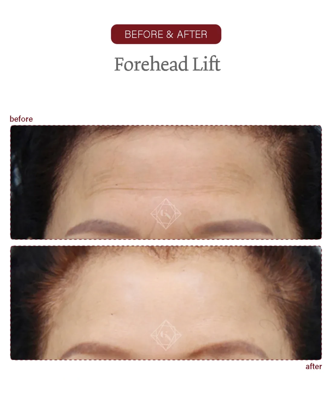 Before and after Forehead Reduction at Garnet Plastic Surgery, Apgujeong Seoul — actual patient