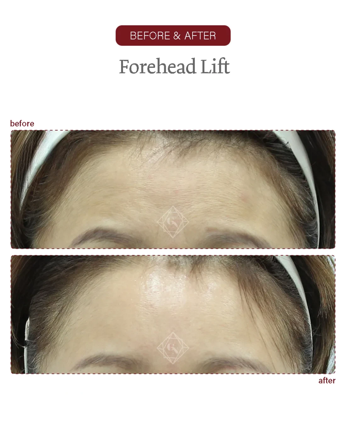 Before and after Forehead Reduction at Garnet Plastic Surgery, Apgujeong Seoul — actual patient