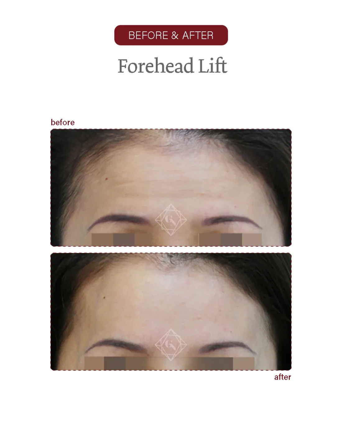 Before and after Forehead Reduction at Garnet Plastic Surgery, Apgujeong Seoul — actual patient