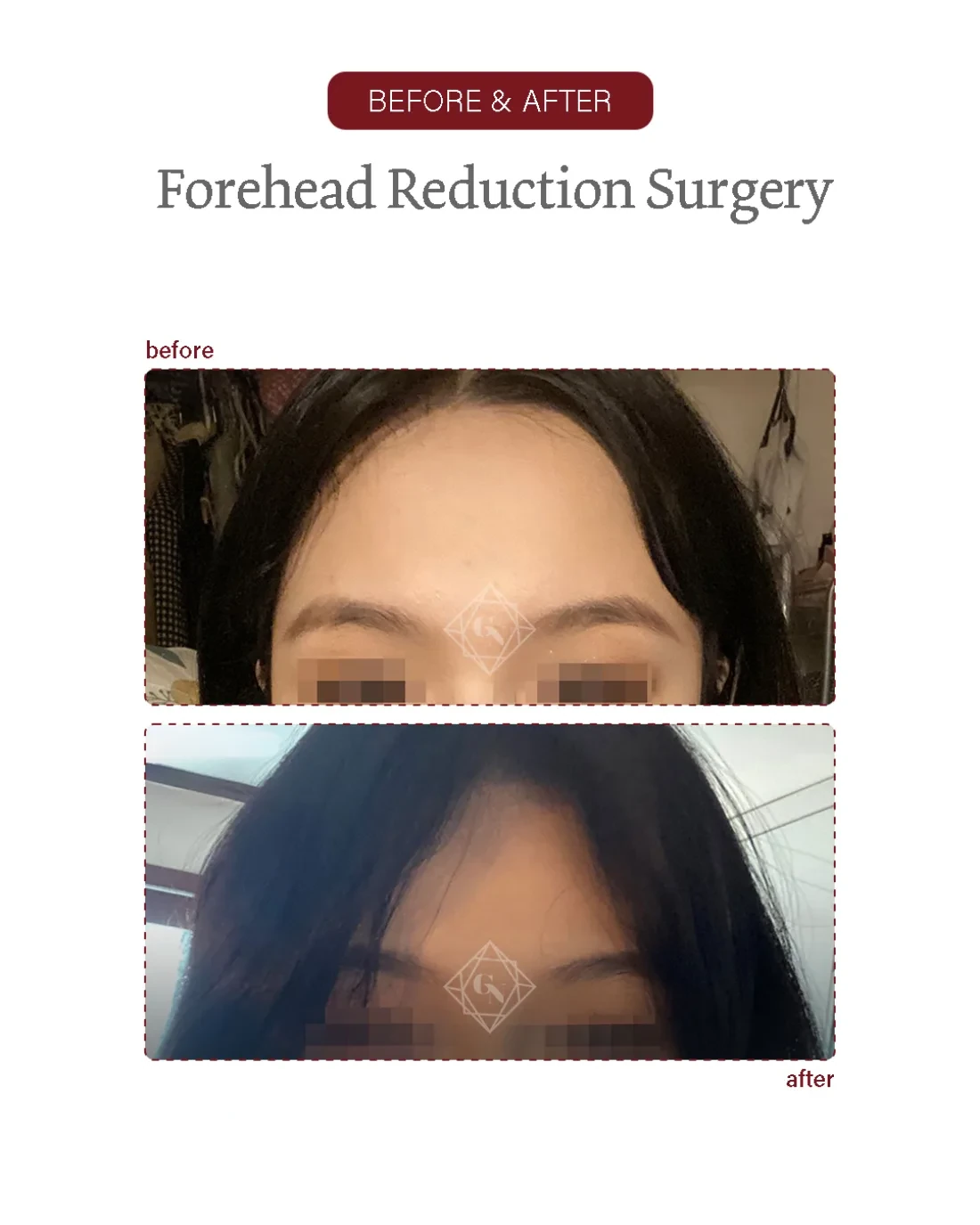 Before and after Forehead Reduction at Garnet Plastic Surgery, Apgujeong Seoul — actual patient