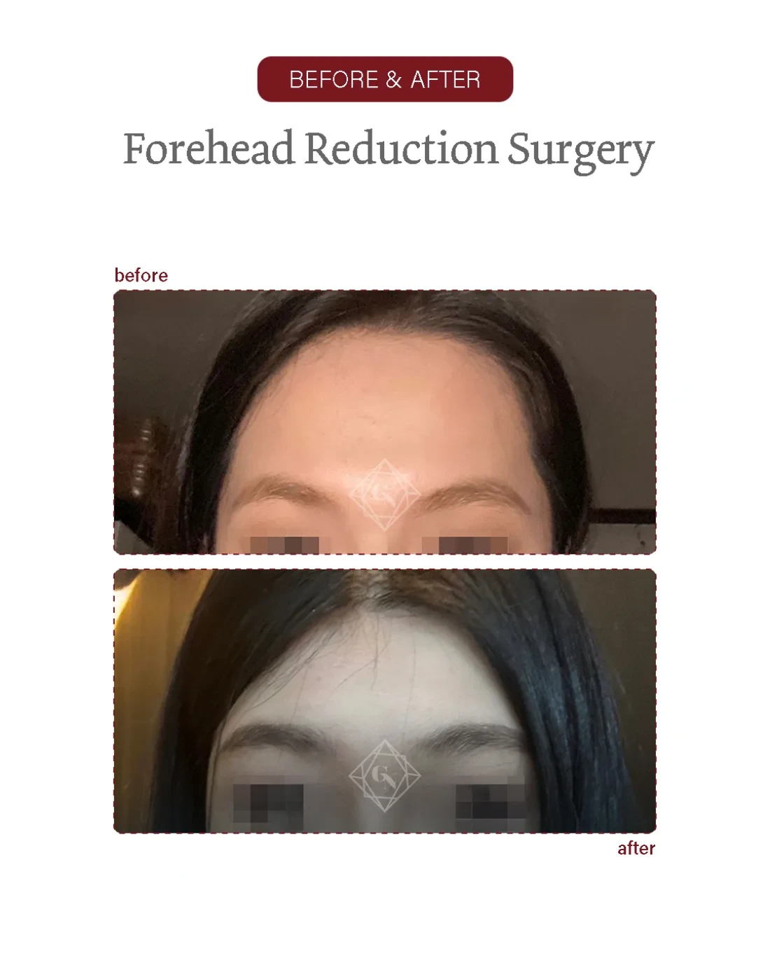 Before and after Forehead Reduction at Garnet Plastic Surgery, Apgujeong Seoul — actual patient