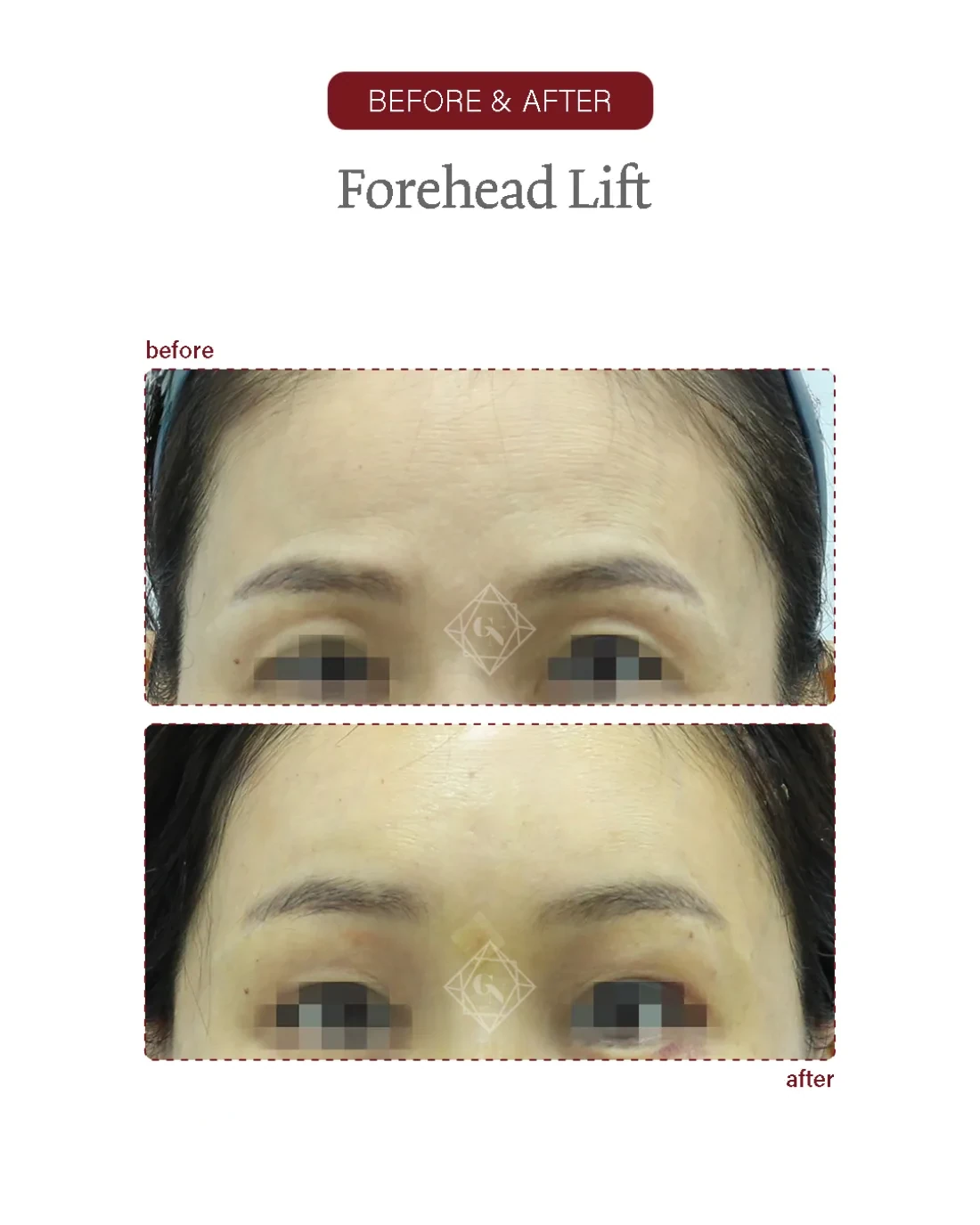 Before and after Forehead Reduction at Garnet Plastic Surgery, Apgujeong Seoul — actual patient