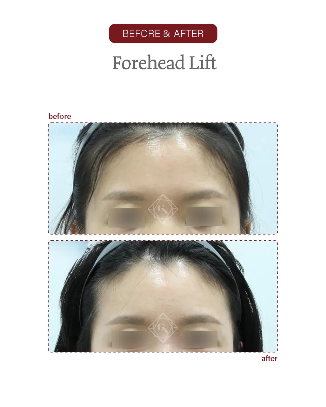 Before and after Forehead Reduction at Garnet Plastic Surgery, Apgujeong Seoul — actual patient