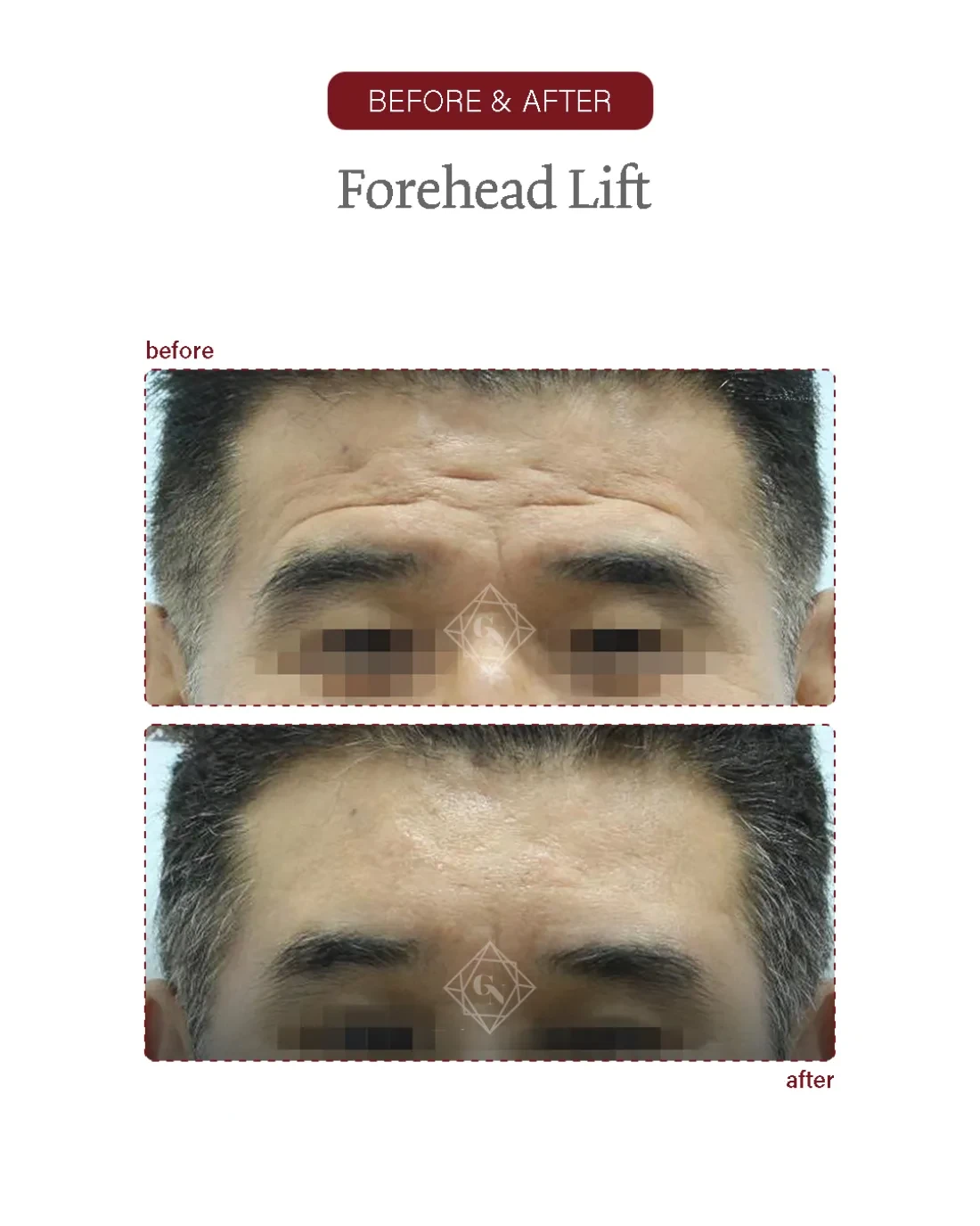 Before and after Forehead Reduction at Garnet Plastic Surgery, Apgujeong Seoul — actual patient