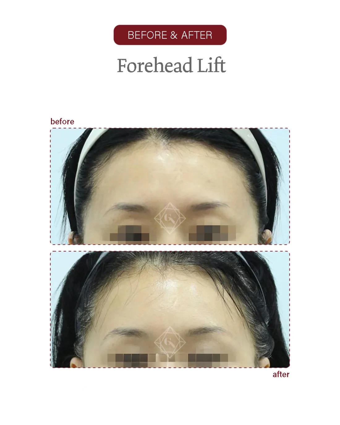 Before and after Forehead Reduction at Garnet Plastic Surgery, Apgujeong Seoul — actual patient