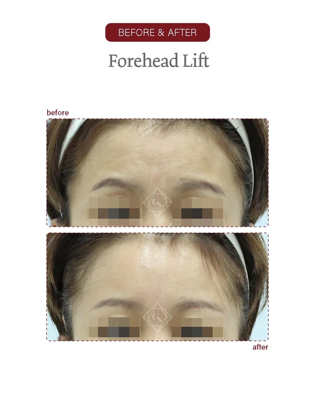 Before and after Forehead Reduction at Garnet Plastic Surgery, Apgujeong Seoul — actual patient