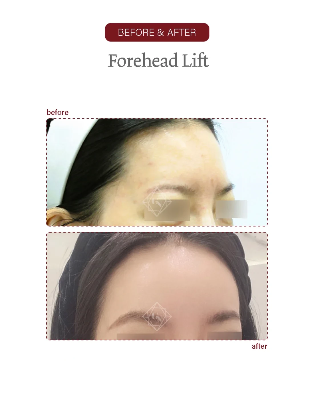 Before and after Forehead Reduction at Garnet Plastic Surgery, Apgujeong Seoul — actual patient