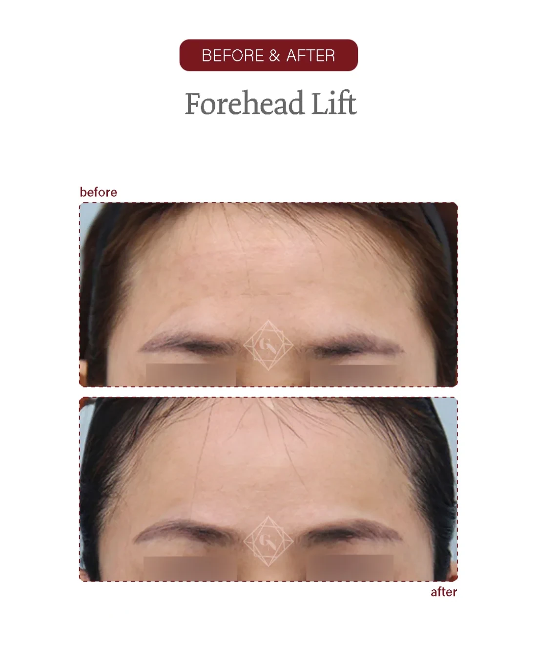 Before and after Forehead Reduction at Garnet Plastic Surgery, Apgujeong Seoul — actual patient
