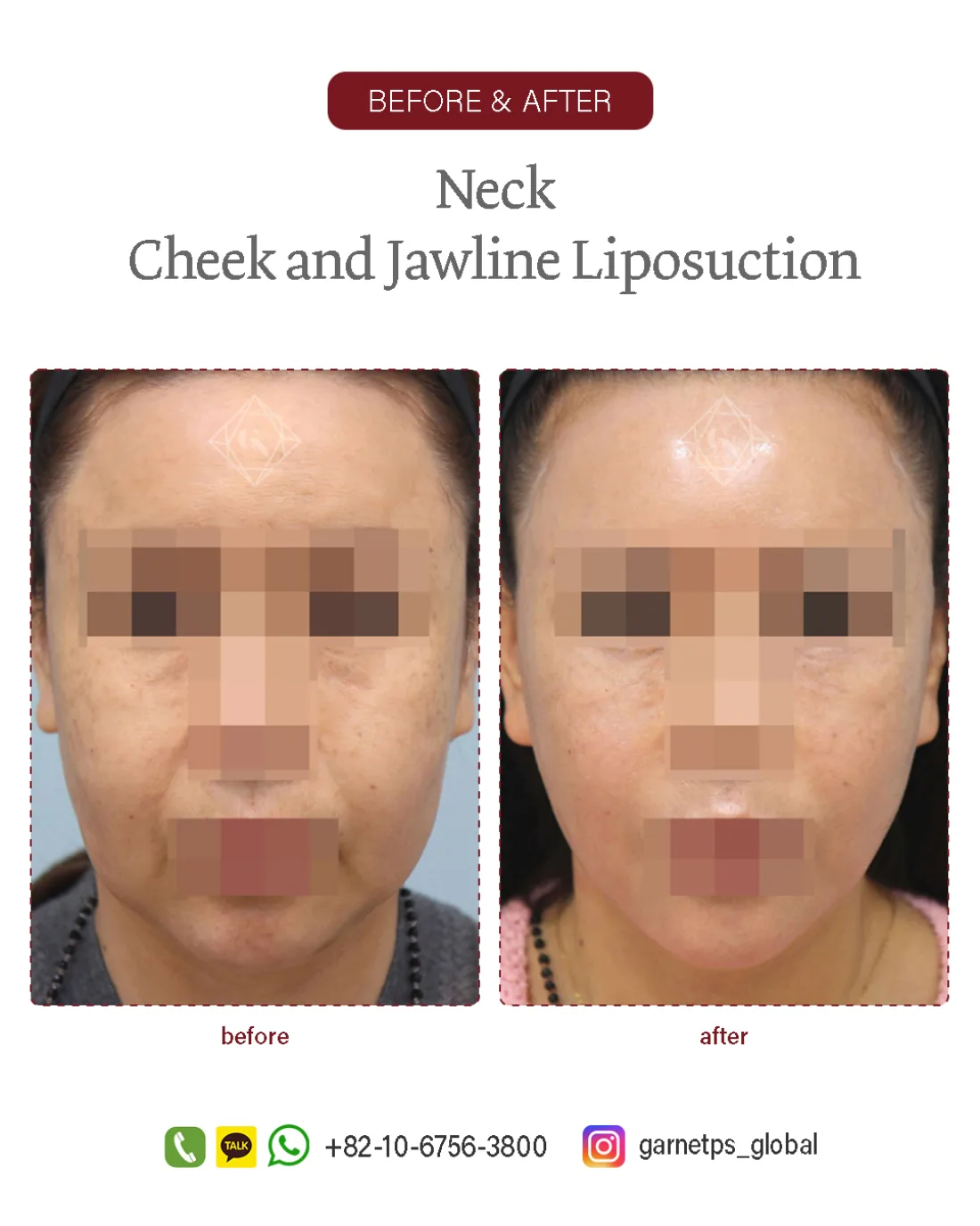 Facial liposuction result at Garnet Plastic Surgery, Apgujeong