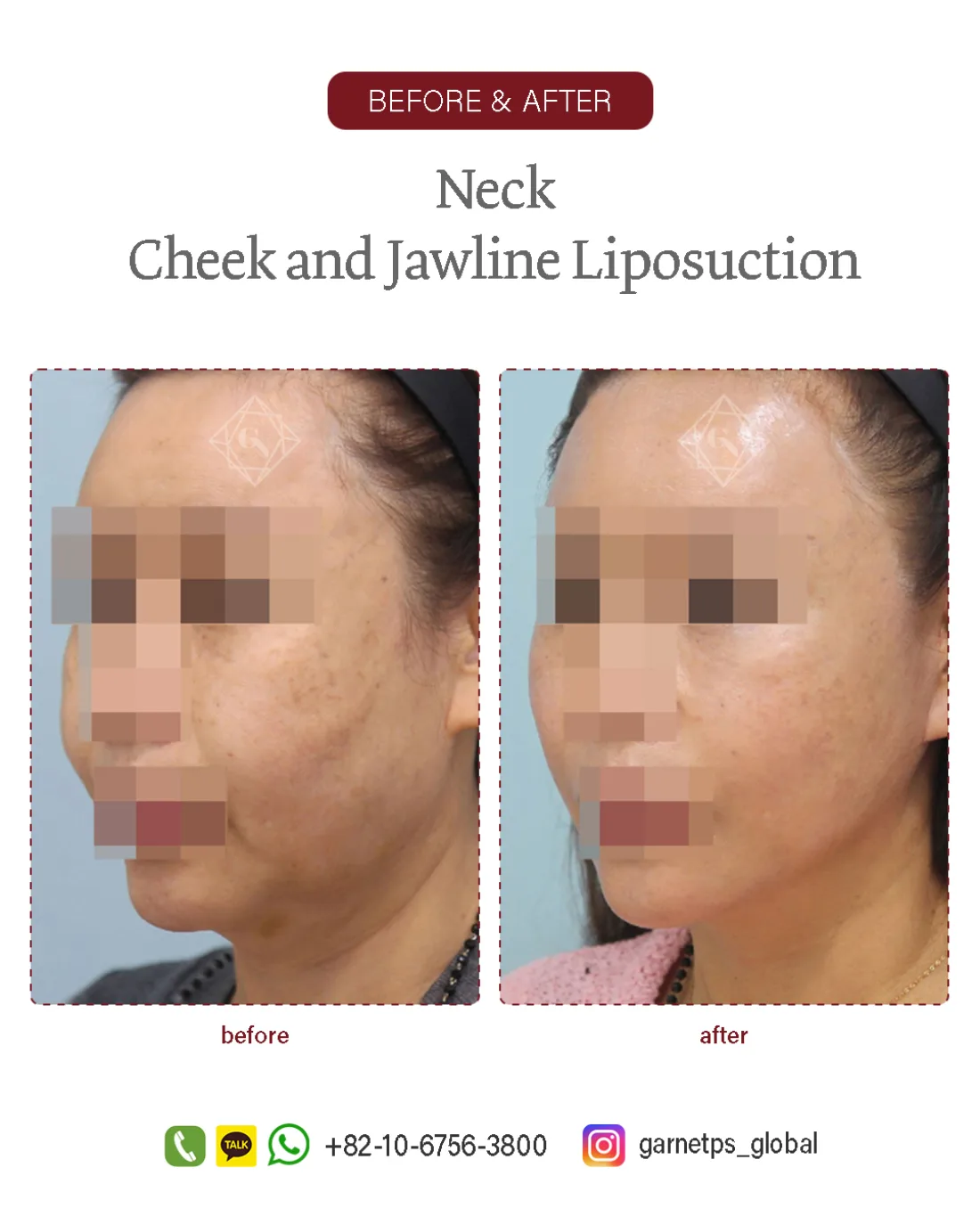 Facial liposuction result at Garnet Plastic Surgery, Apgujeong