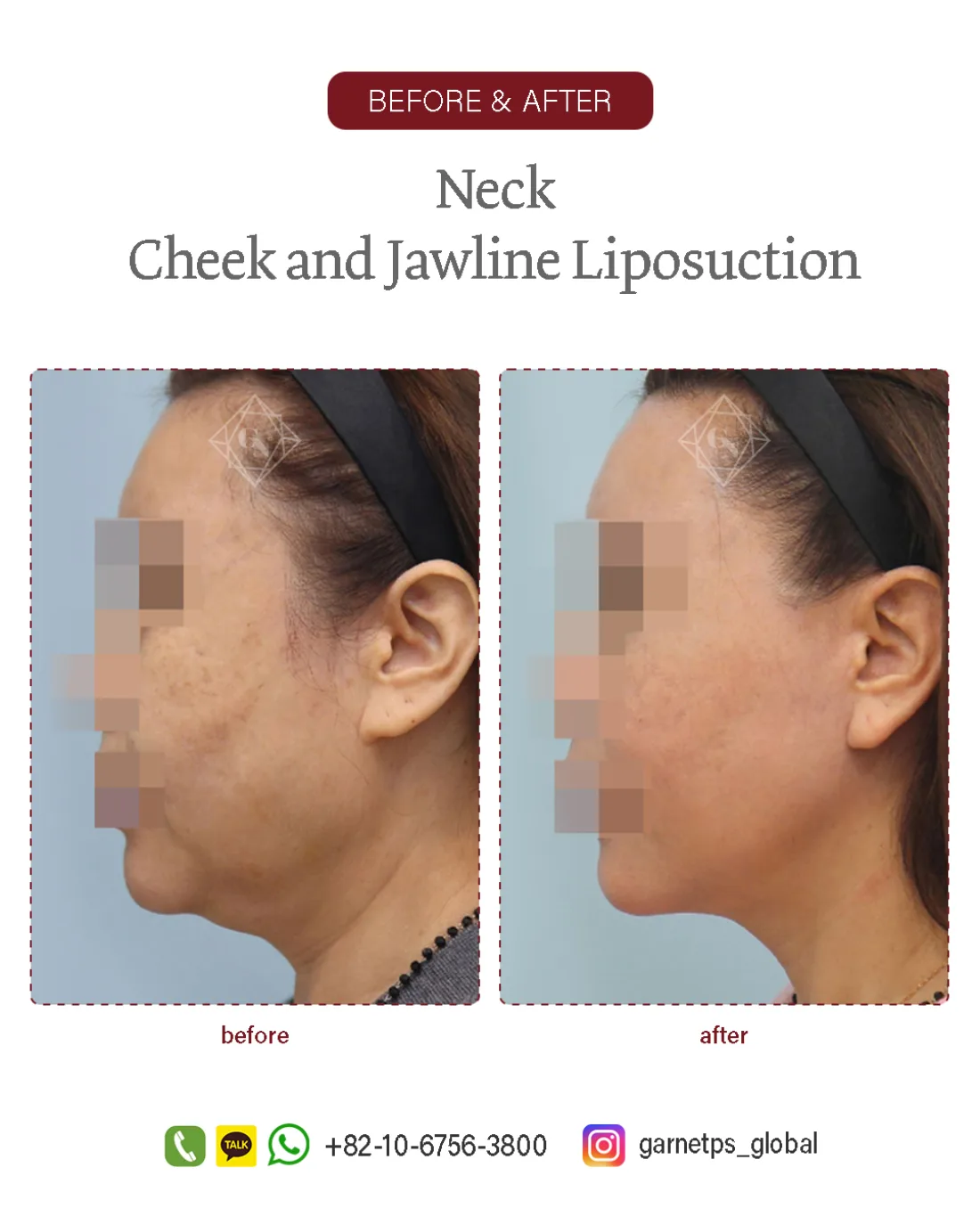 Facial liposuction result at Garnet Plastic Surgery, Apgujeong