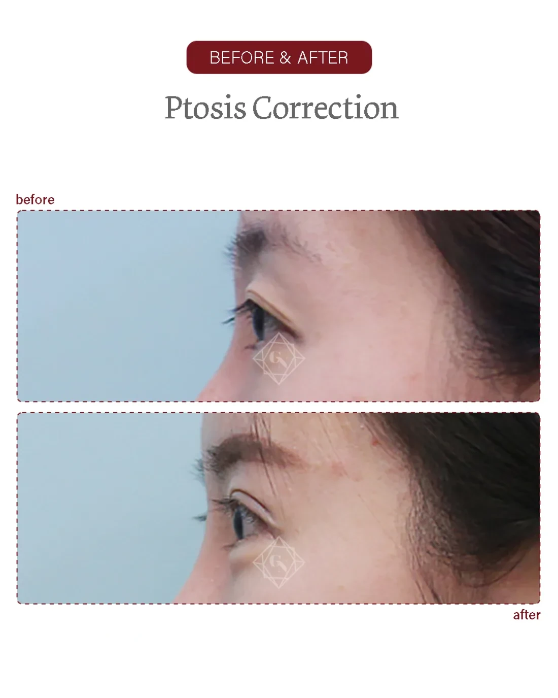 Ptosis correction result at Garnet Plastic Surgery, Apgujeong