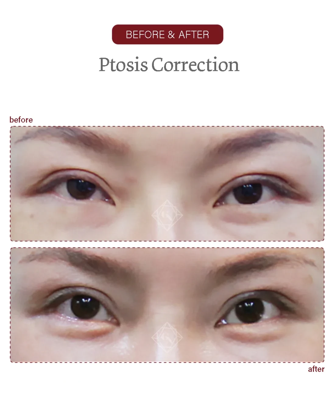 Ptosis correction result at Garnet Plastic Surgery, Apgujeong