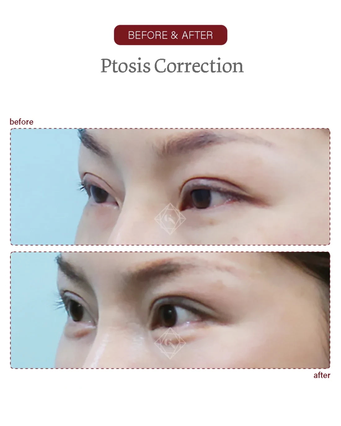 Ptosis correction result at Garnet Plastic Surgery, Apgujeong