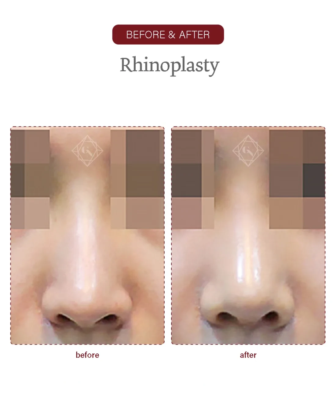Rhinoplasty result at Garnet Plastic Surgery, Apgujeong