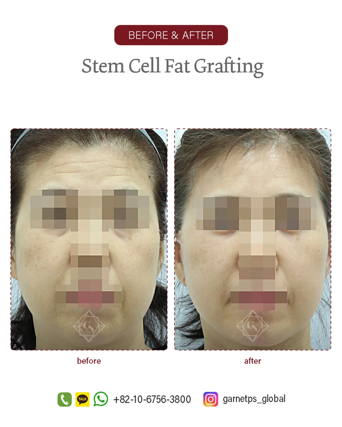 Stem cell fat grafting result at Garnet Plastic Surgery, Apgujeong