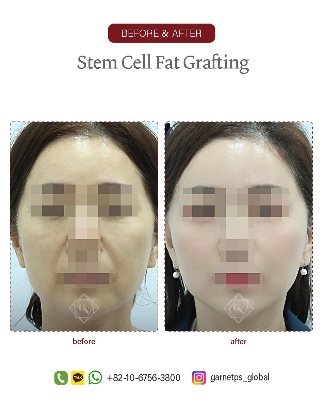 Stem cell fat grafting result at Garnet Plastic Surgery, Apgujeong