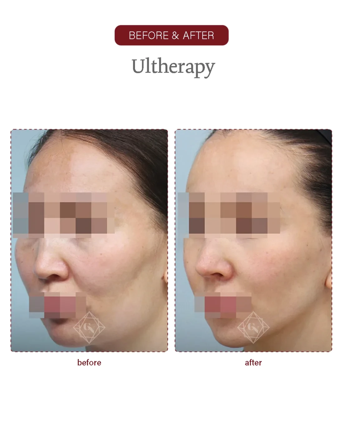 Deep-plane facelift result at Garnet Plastic Surgery, Apgujeong