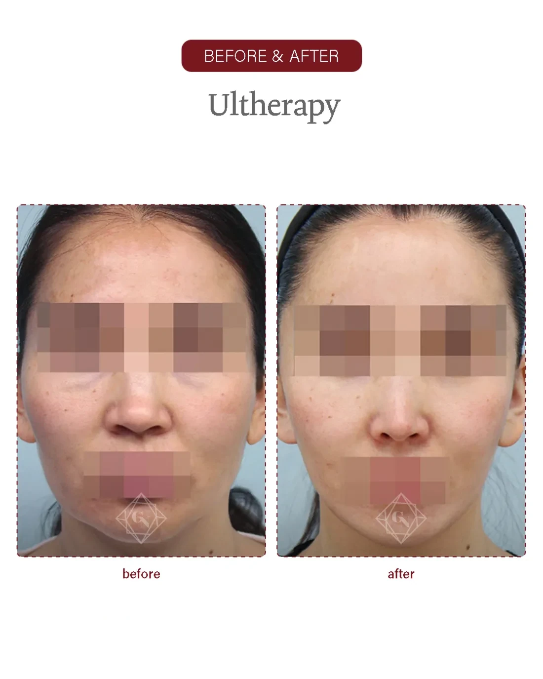 Deep-plane facelift result at Garnet Plastic Surgery, Apgujeong