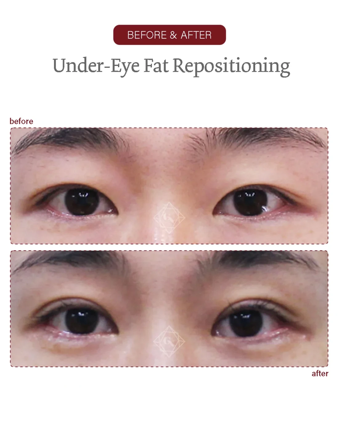 Under-eye fat repositioning result at Garnet Plastic Surgery, Apgujeong