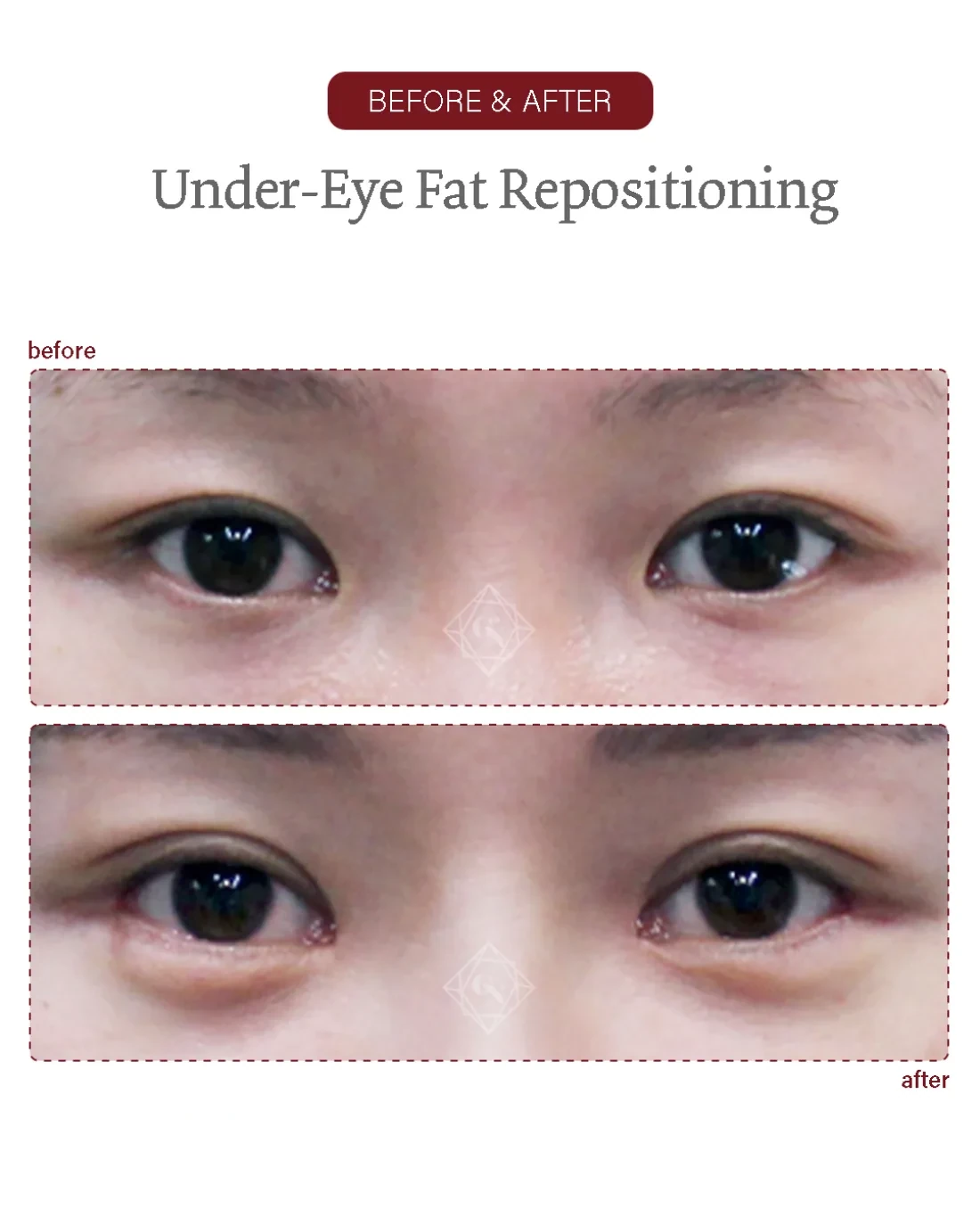 Under-eye fat repositioning result at Garnet Plastic Surgery, Apgujeong