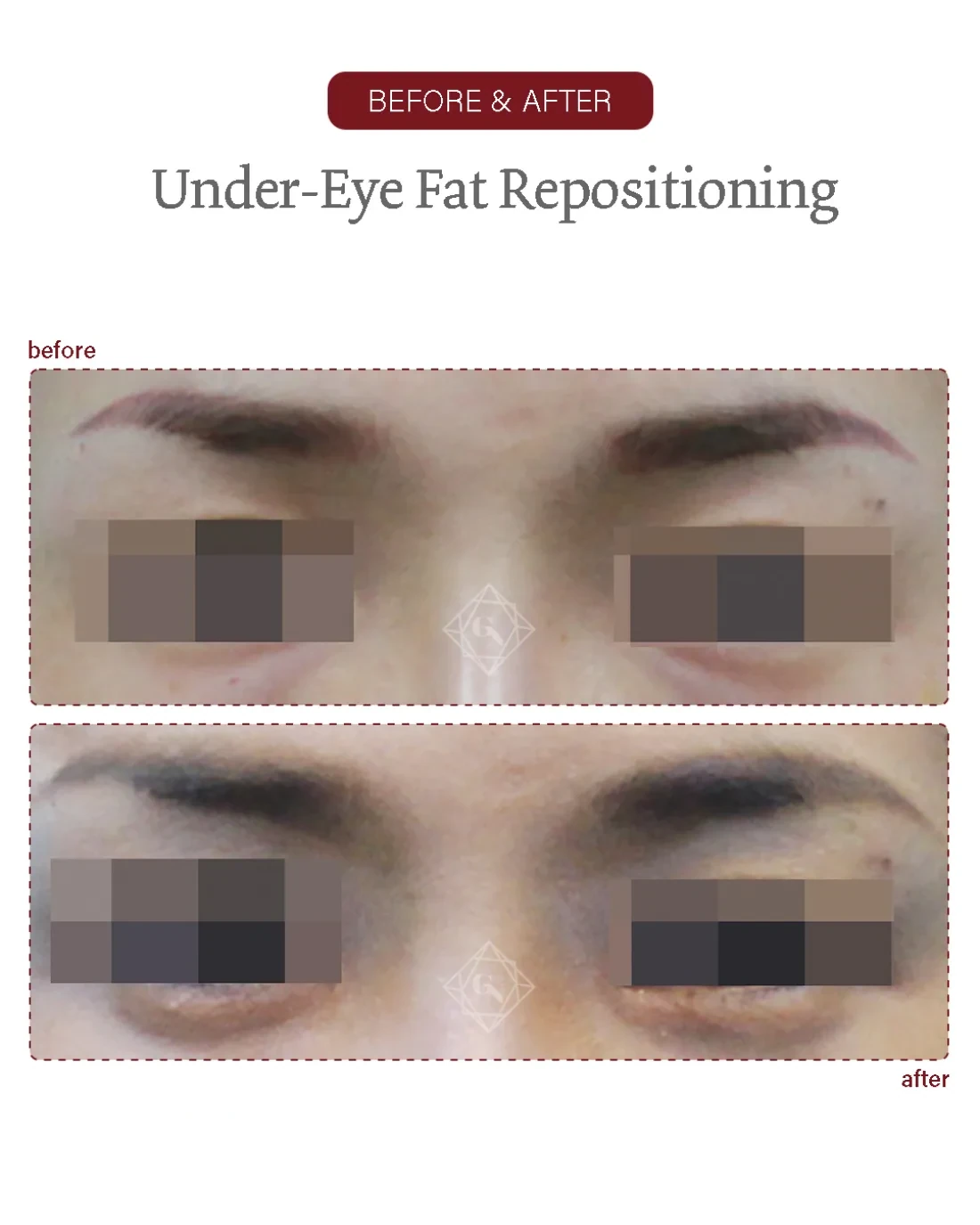 Under-eye fat repositioning result at Garnet Plastic Surgery, Apgujeong