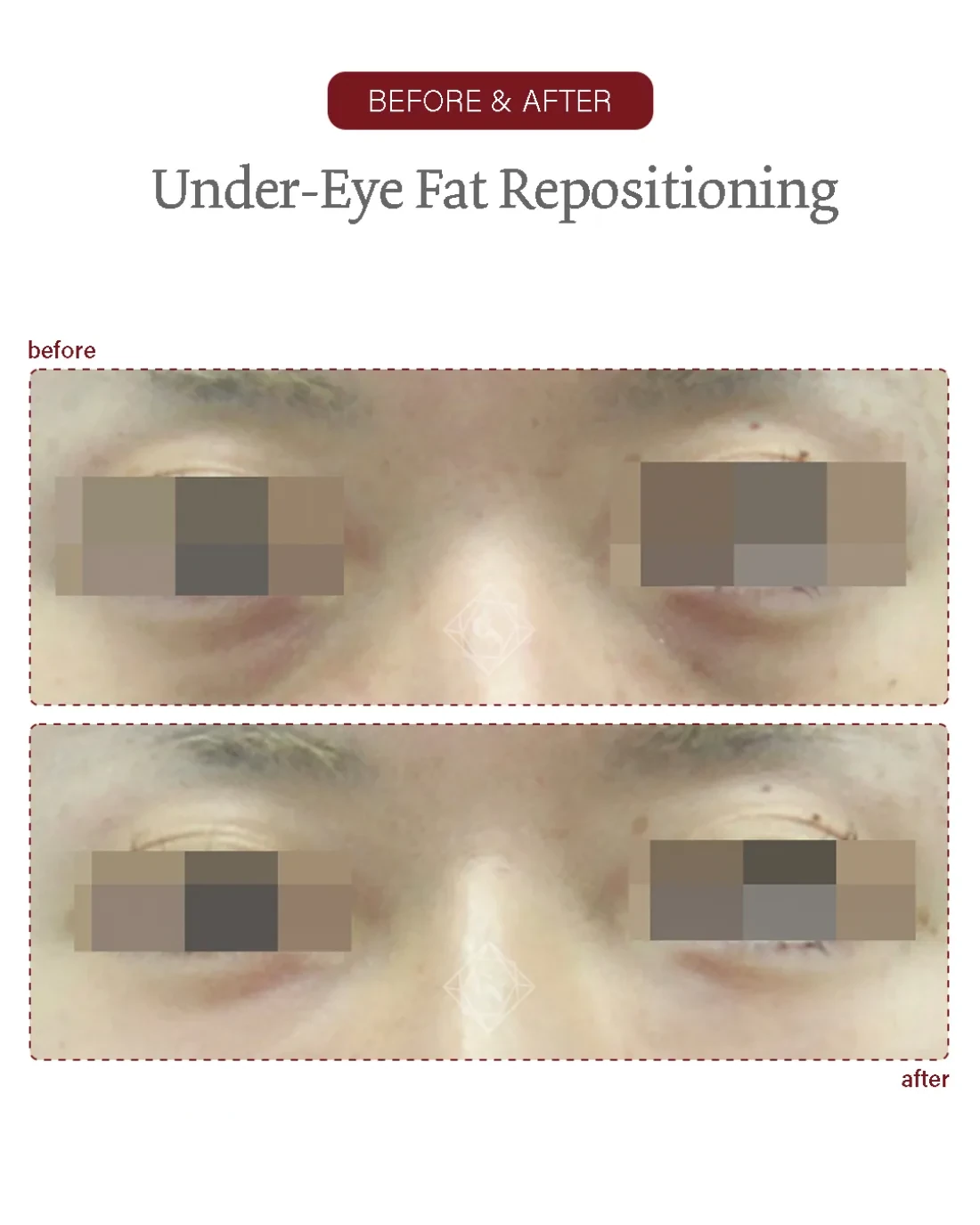 Under-eye fat repositioning result at Garnet Plastic Surgery, Apgujeong