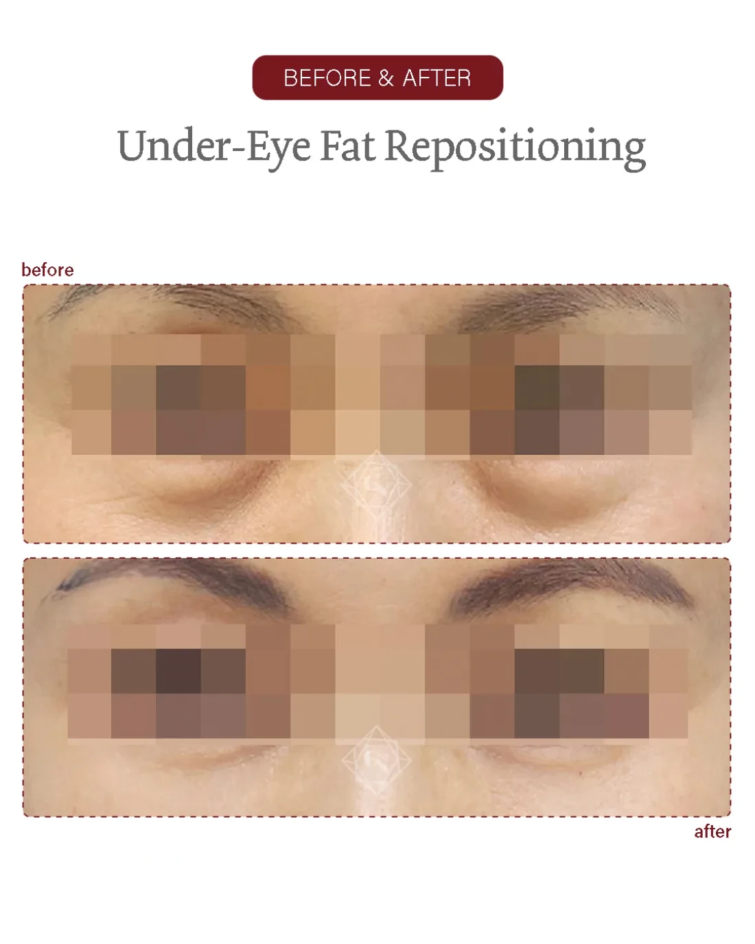 Under-eye fat repositioning result at Garnet Plastic Surgery, Apgujeong
