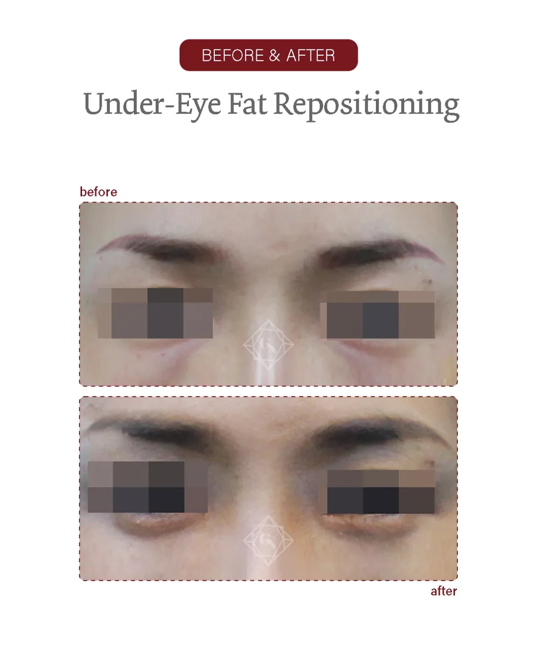 Under-eye fat repositioning result at Garnet Plastic Surgery, Apgujeong
