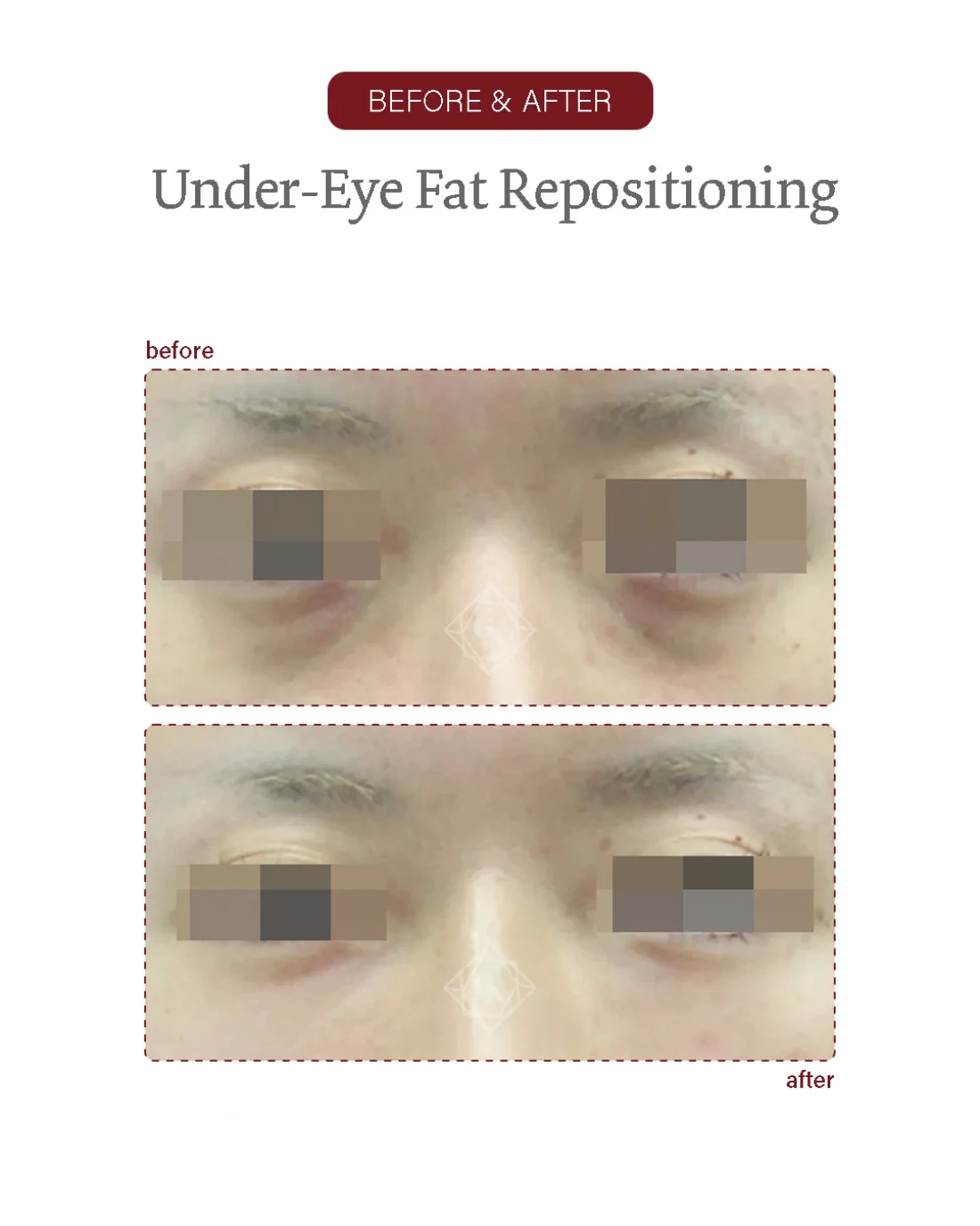 Before and after Under-eye Fat Repositioning at Garnet Plastic Surgery, Apgujeong Seoul — actual patient