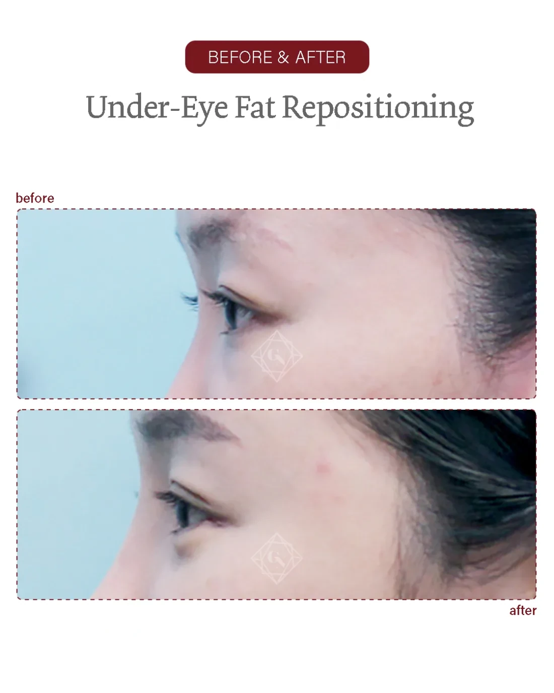 Before and after Under-eye Fat Repositioning at Garnet Plastic Surgery, Apgujeong Seoul — actual patient