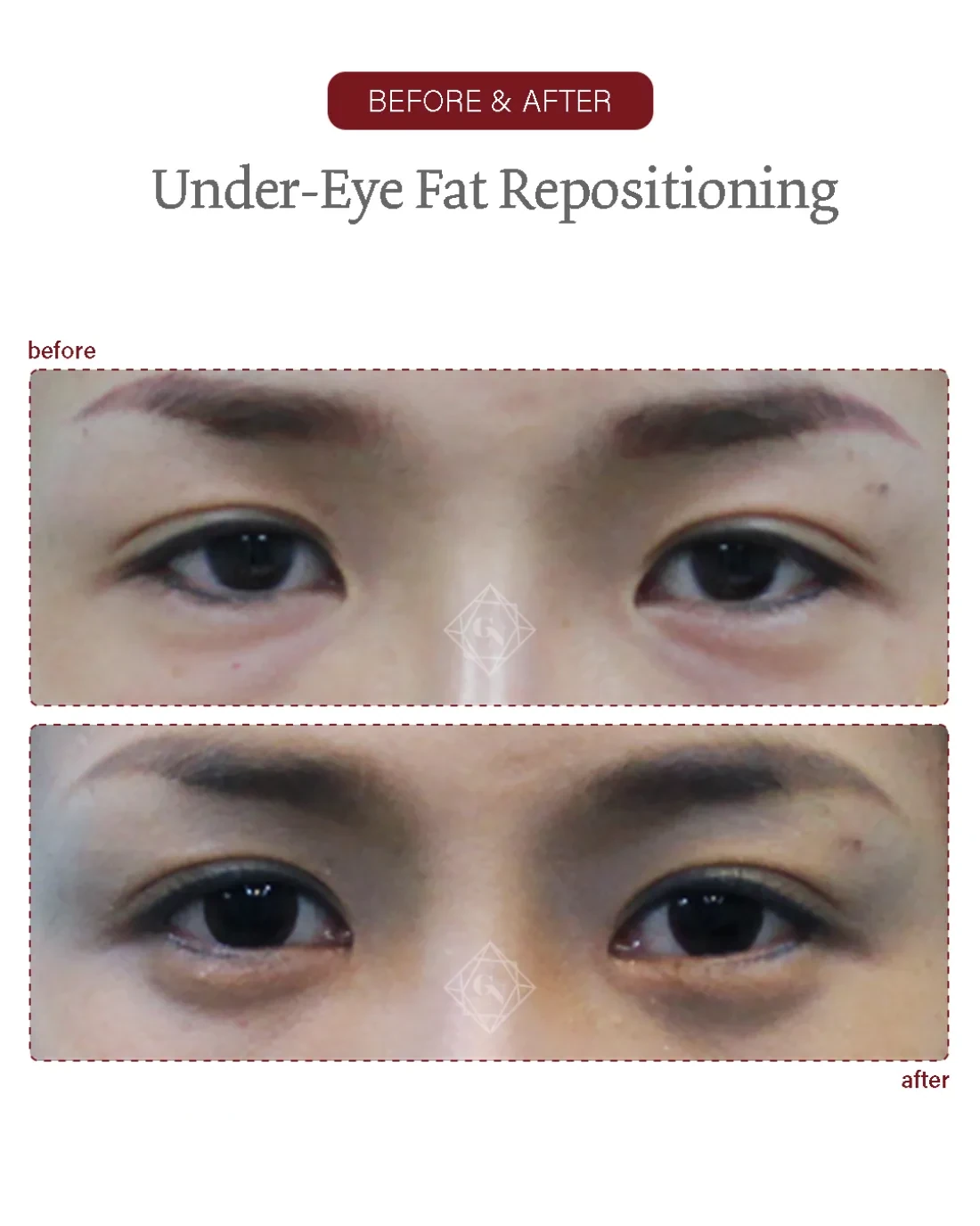 Before and after Under-eye Fat Repositioning at Garnet Plastic Surgery, Apgujeong Seoul — actual patient