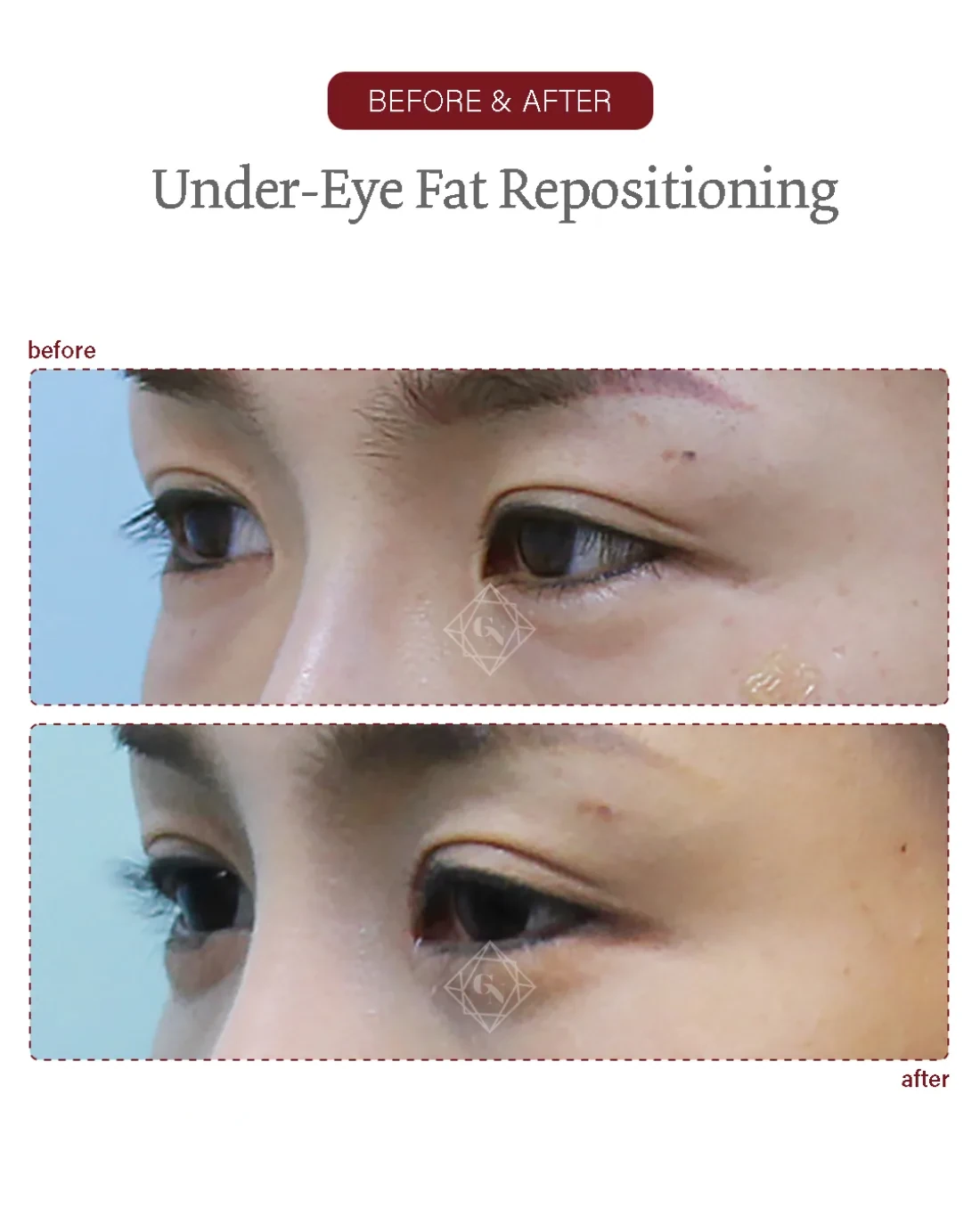 Before and after Under-eye Fat Repositioning at Garnet Plastic Surgery, Apgujeong Seoul — actual patient