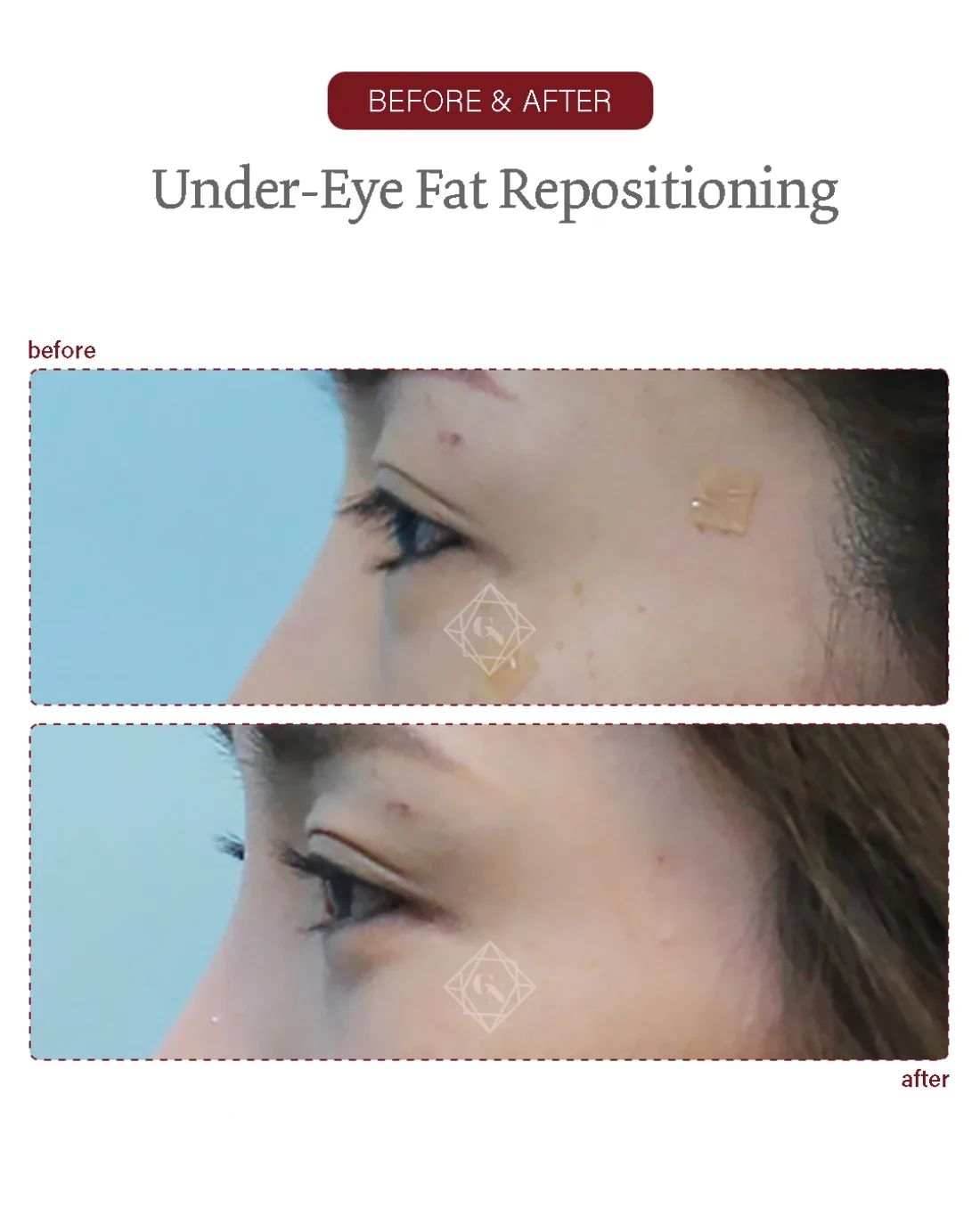 Before and after Under-eye Fat Repositioning at Garnet Plastic Surgery, Apgujeong Seoul — actual patient
