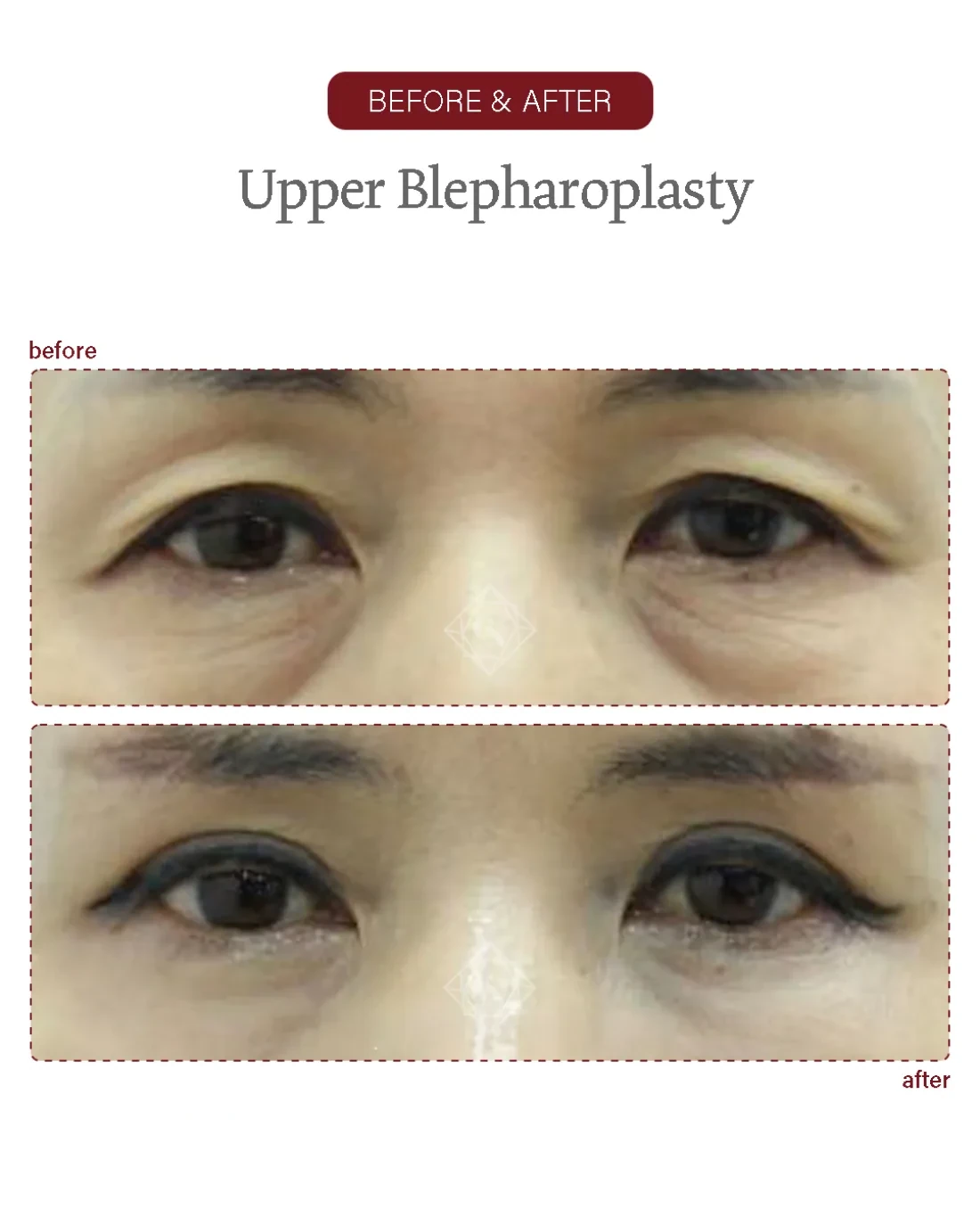 Lower blepharoplasty result at Garnet Plastic Surgery, Apgujeong